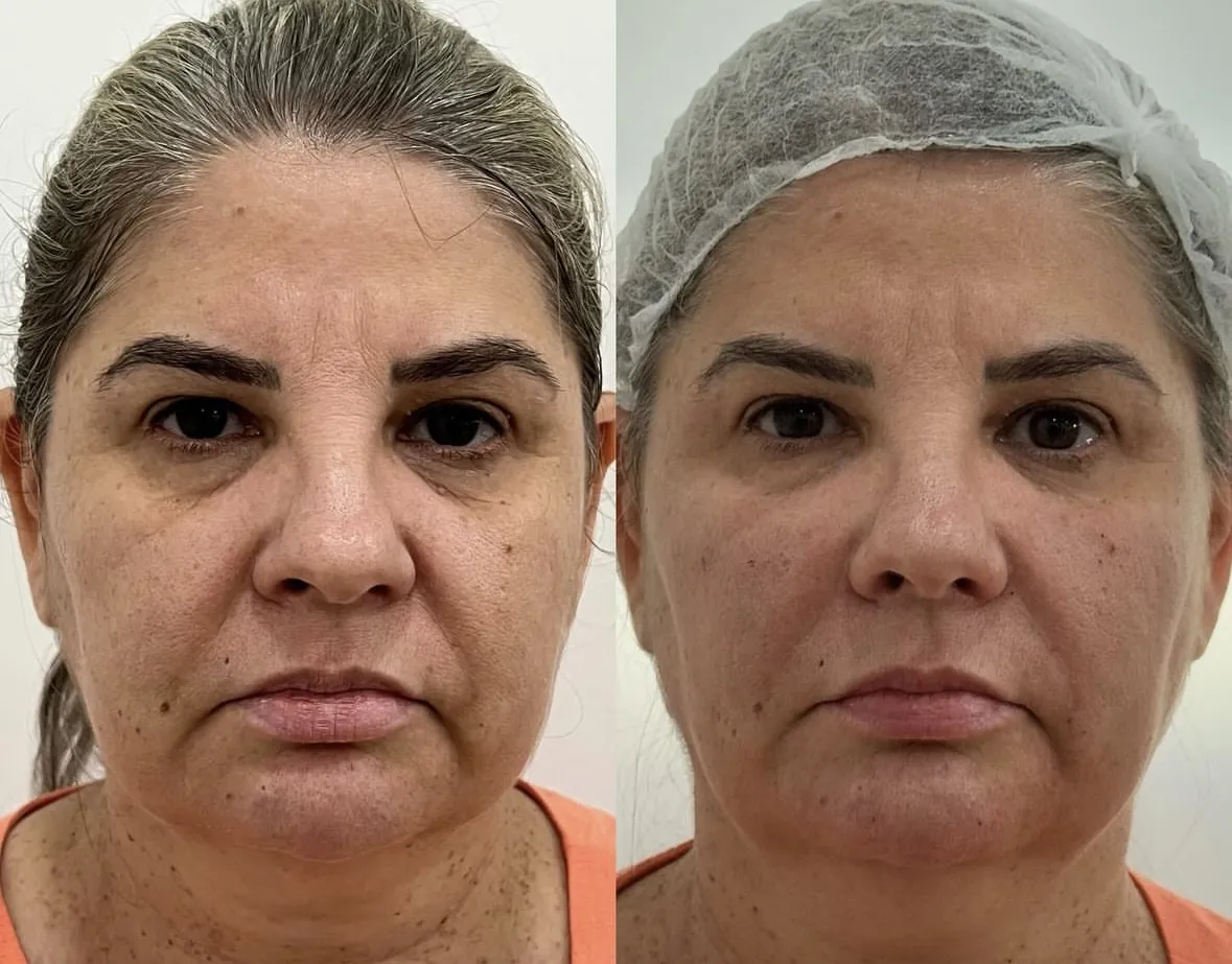 Before and After - Lymphatic Drainage: Swelling Reduction